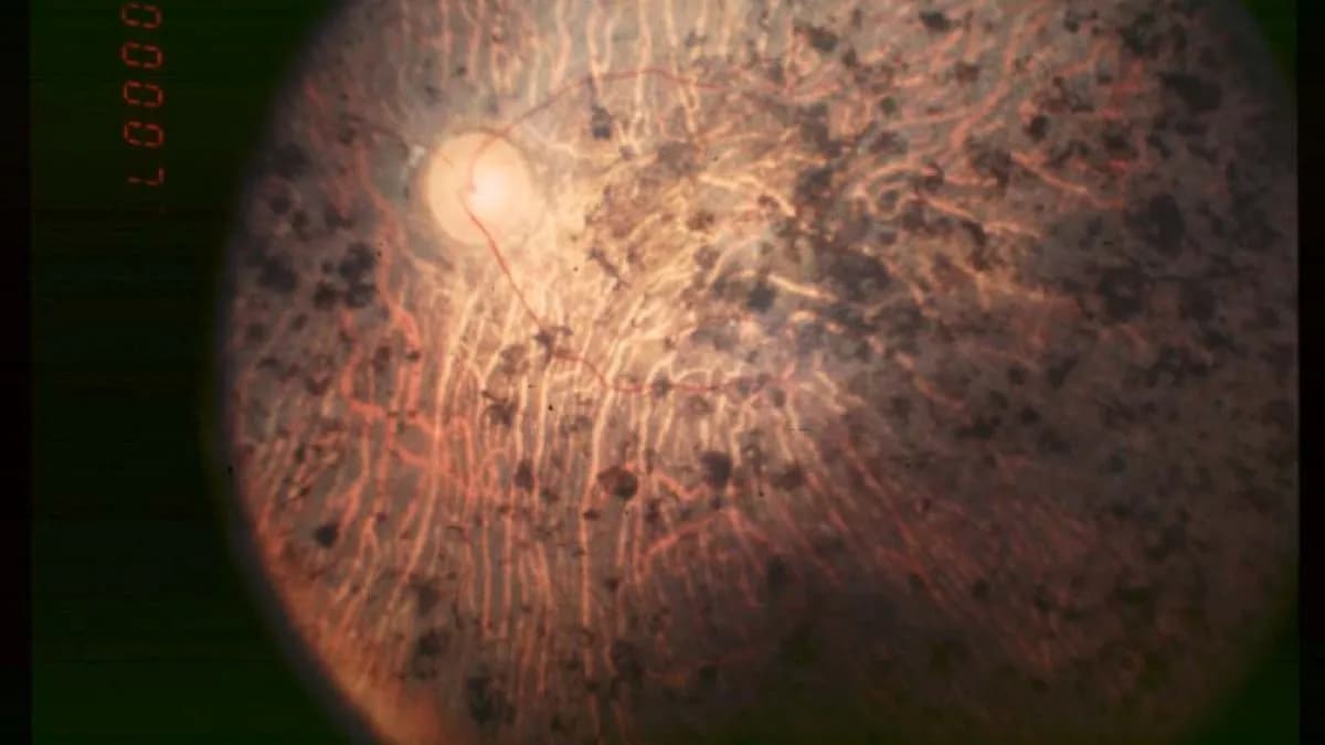 A fundus photograph of the retina of a patient with end-stage retinitis pigmentosa, showing pigment deposits across the retina, published in 2006, a clinical illustration of the disease and not an image from the trial