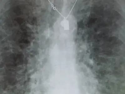 A chest X-ray showing the scarring pattern of pulmonary fibrosis, the disease rentosertib was designed to treat